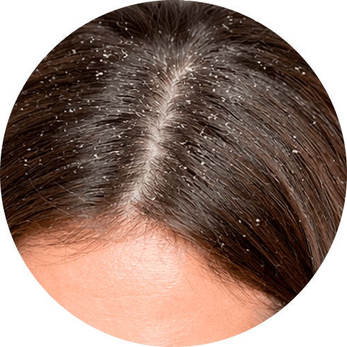 tipos de caspa: caspa seca