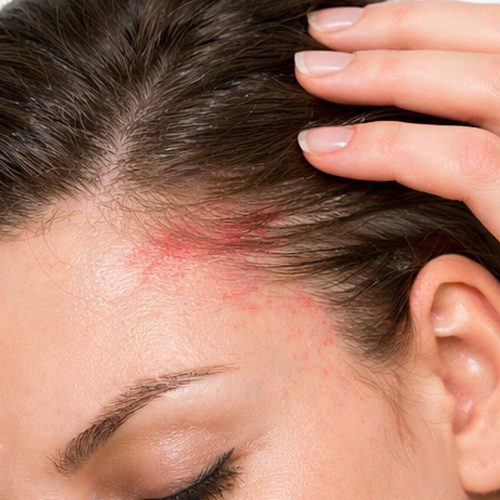 tratamientocapilarburgos_sensiblidadeirritacion
