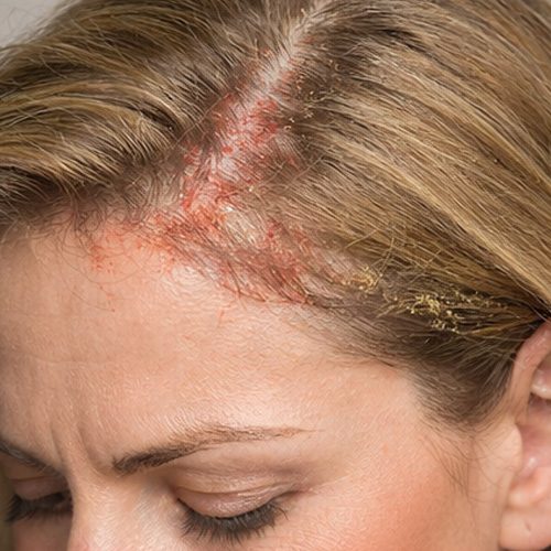 tratamientoparalacaspa_dermatitisseborreica